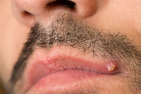 Blackheads On Lips And Lip Line Causes And Removal Skincarederm