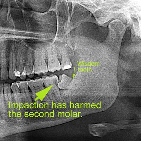 Should Wisdom Teeth Be Removed Roman Dental