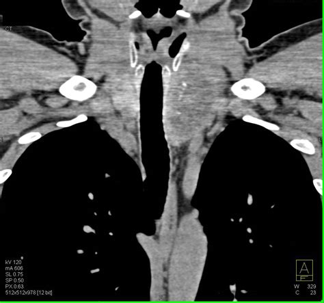 Substernal Thyroid Pushes On Airway Chest Case Studies Ctisus Ct