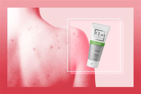 The Best Body Acne Treatments According To Experts And Reviews
