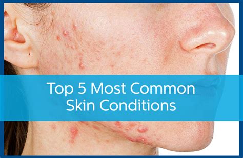 All About Common Skin Disorders