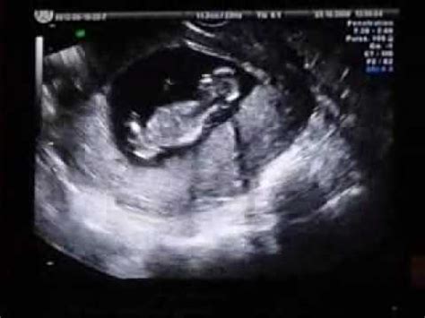 Start studying chapter 14.assessment of fetus. 1er echo du bébé - A 3 mois - YouTube