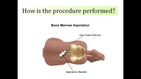 Bone marrow examination refers to the pathologic analysis of samples of bone marrow obtained by bone marrow biopsy (often called a trephine biopsy) and bone marrow aspiration. Bone marrow biopsy - YouTube