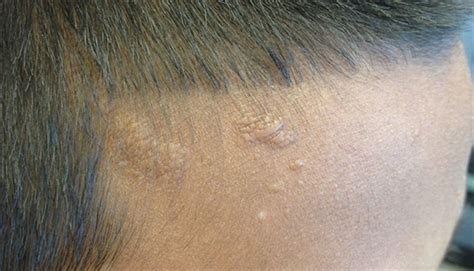 Clinical Challenge Facial Lesions In A Patient With Seizures Mpr