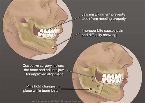 Jaw Surgery