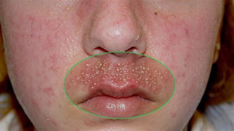 Cystic Acne Blackheads And Pimples Extraction On Face Acne Treatment