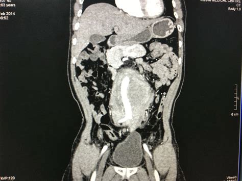 Vietnamese Medic Ultrasound Case Periaortic Mass Dr Phan Thanh