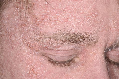 Severe Eczema On The Face Stock Image C0400988 Science Photo Library
