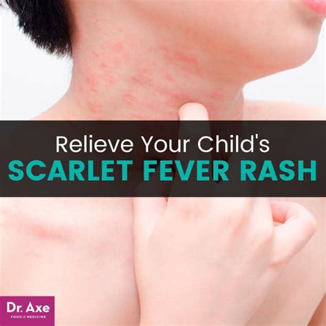 Dont Ignore These Scarlet Fever Warning Signs Scarlet Fever Rash