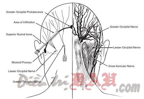 Third Occipital Nerve Block