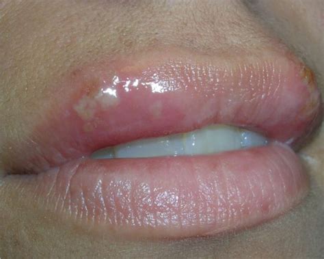 Cold Sore Stages With Pictures The 5 Stages Of Cold Sore Outbreak
