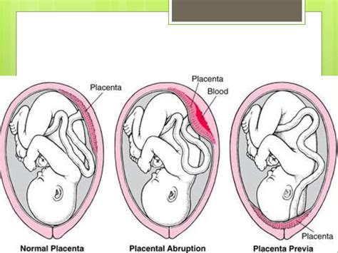 Placental Abruption Online Presentation