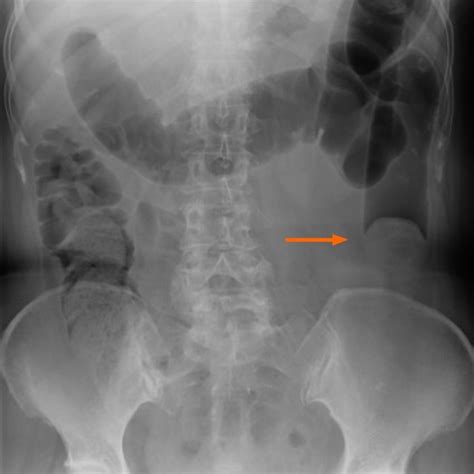 Abdominal X Ray The Colon Is Filled With Air From The Ascending Colon