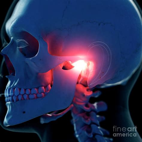 Illustration Of A Painful Temporomandibular Joint Photograph By