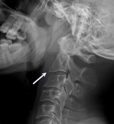 Subaxial Cervical Vertebral Body Fractures Spine Orthobullets