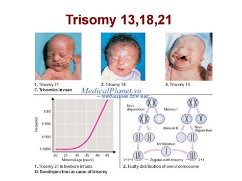Mengenal Tiga Kelainan Trisomi Pada Ibu Hamil Down Edward Dan Patau Syndrome