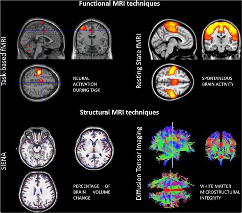 Frontiers Neuroplasticity And Motor Rehabilitation In Multiple