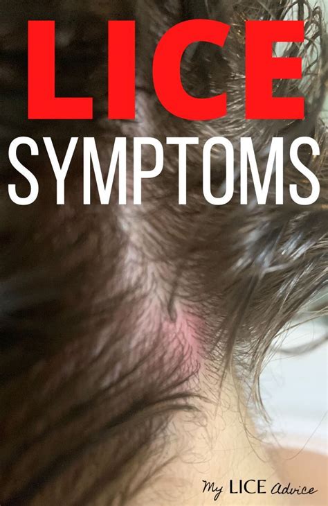 17 Lice Symptoms With Pictures Signs That You Have Head Lice In 2021