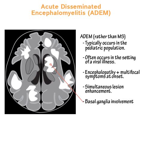 Adem Acute Disseminating Encephalomyelitis Rituximab