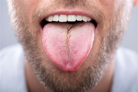 Causes Effects And Signs Of Fissured Tongue Facty Health