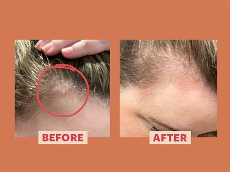 Update 71 Scalp Psoriasis Hair Loss Super Hot In Eteachers