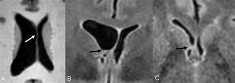 Lateral Ventricular Asymmetry In A 56 Year Old Woman Referred From A