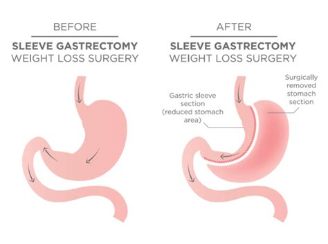 Laparoscopic Sleeve Gastrectomy Lsg Ideal Body Institute