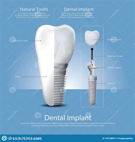 Dientes Humanos Y Implante Dental Ilustración Del Vector Ilustración