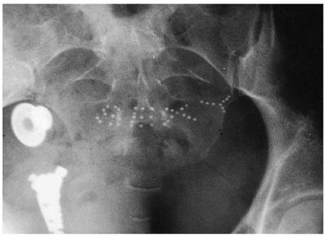 Radiographic Artifacts Radiology Key