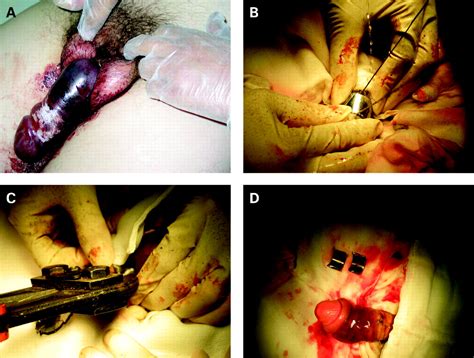 Emergency Management Of Penile Strangulation A Case Report And Review