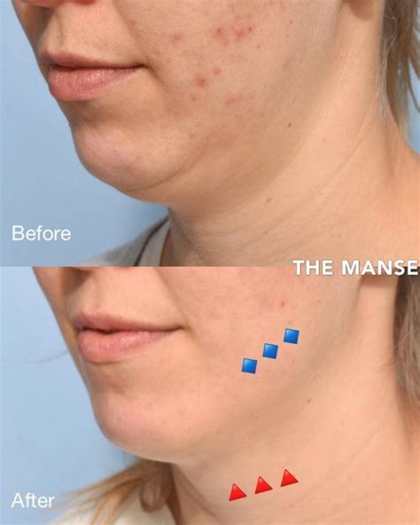 Double Chin Injections Best Clinic Sydney For Dermal Fillers