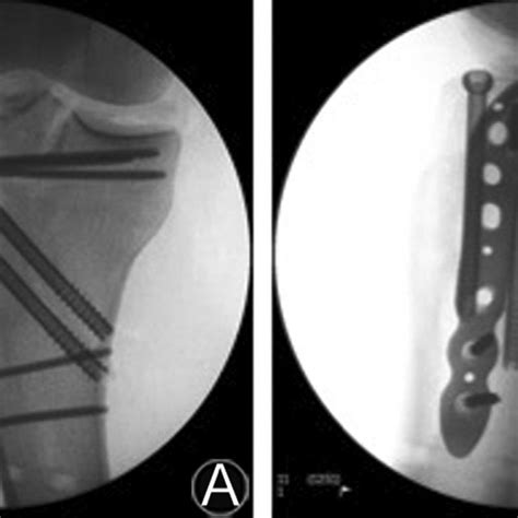 Typical Schatzker Iv Fracture Pattern Download Scientific Diagram