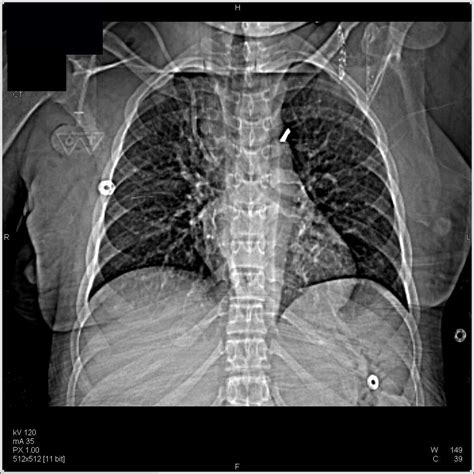 Mediastinal Abscess Chest Case Studies Ctisus Ct Scanning