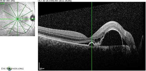 Polypoidal Choroidal Vasculopathy Pcv