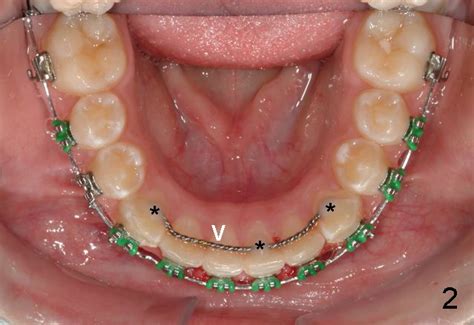 Be sure you understand how to use it. How to fabricate and floss a lingual fixed retainer ...