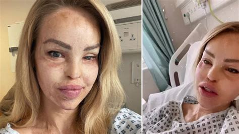 Katie Piper Shares Photograph Of Acid Attack Injur Katie Piper Nda Uk