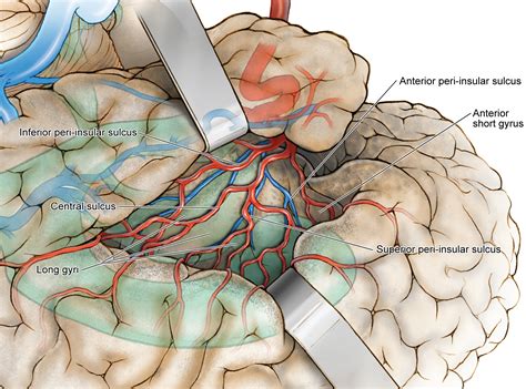 Insular Glioma Surgery An Evolution Of Thought And Practice In