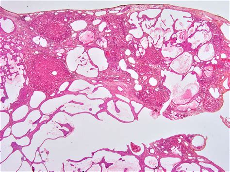 Pathology Outlines Hemangioma And Variants