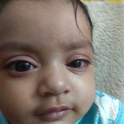 Asktheexpert My Baby Is One Yearhe Is Suffering Eye Infectionhis