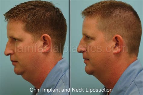 Neck Liposuction Dallas Cosmetic Facial Surgery Procedures Plano Tx