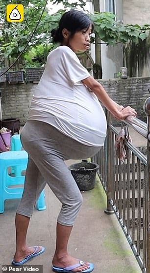 Chinese Mother Of Two Whose Belly Ballooned By Pounds Due To Ovarian