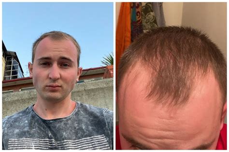 Минчанин решился на пересадку волос Показываем фото до и после