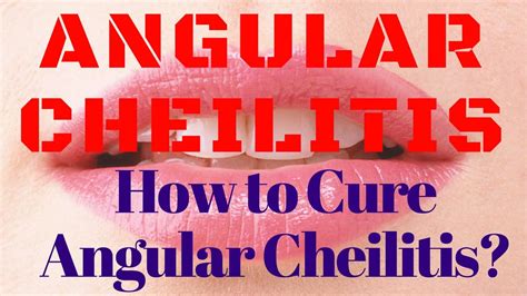 Angular Cheilitis Cure How To Cure Angular Cheilitis Tips To Dry Out