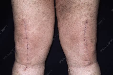 Knee Surgery Scars Stock Image M332 0073 Science Photo Library