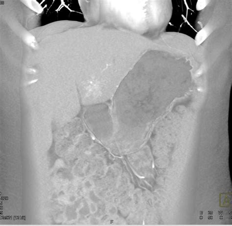 Focal Nodular Hyperplasia Fnh Left Lobe Of Liver And Hemangioma In