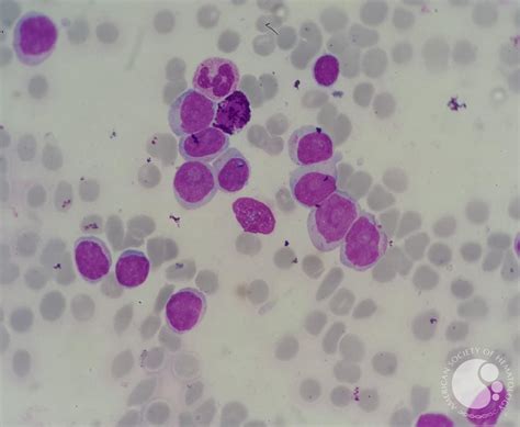 Chronic Lymphocytic Leukemia Cll With Presence Of Pro Lymphocytes 5