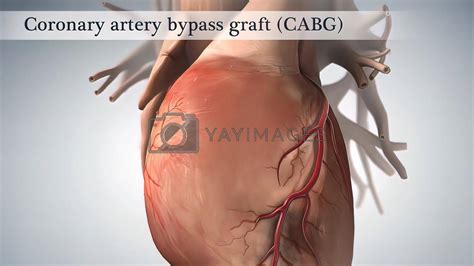 Coronary Artery Bypass Surgery Is Done Using A Healthy Blood Vessel