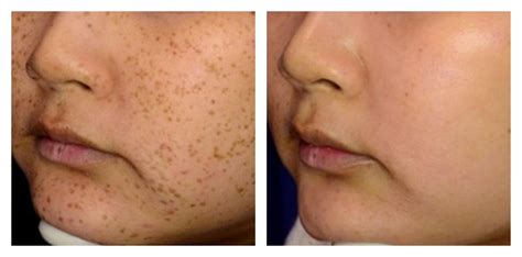 Sun Spots Freckles And Skin Pigmentation Removal Services Renew