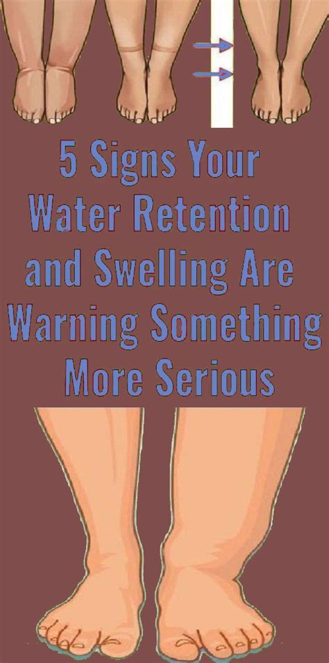5 Signs Your Water Retention And Swelling Are Warning Something More