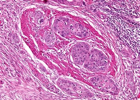 Esophageal Carcinoma At 10x Magnification Microscopyu